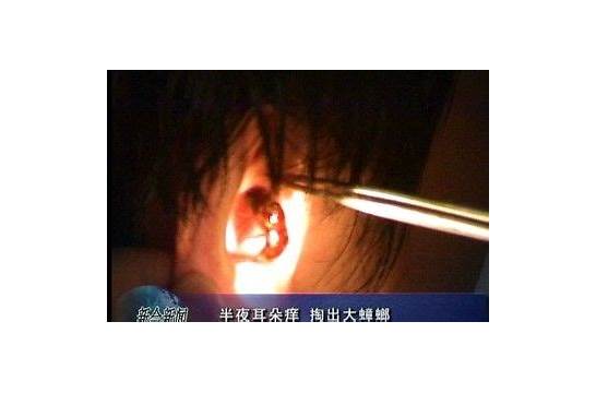 一男子睡觉时蟑螂入耳 耳膜被咬穿 更恐怖的是蟑螂有个偏好……