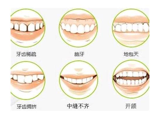 矫正牙齿是怎样的体验 感受是什么