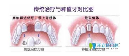 镶牙多少钱 种植牙有什么优势